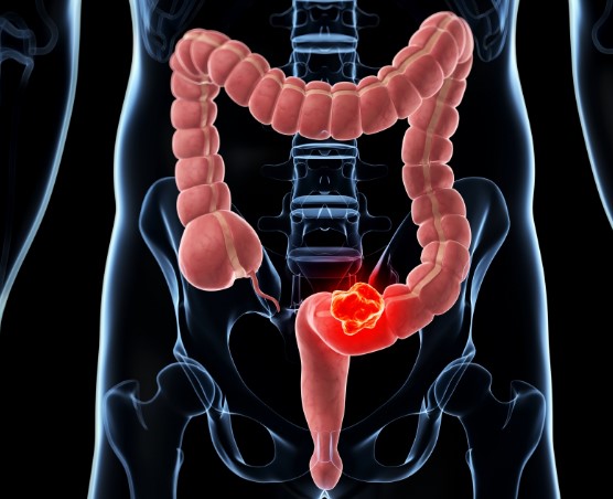 Como reconhecer os sinais do câncer de cólon?